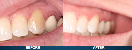 Discolored Teeth